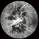 FA Early Phase Optic Disc Edema FA Early Phase Optic Disc Edema